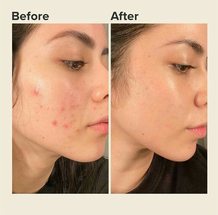 Acne Serum
